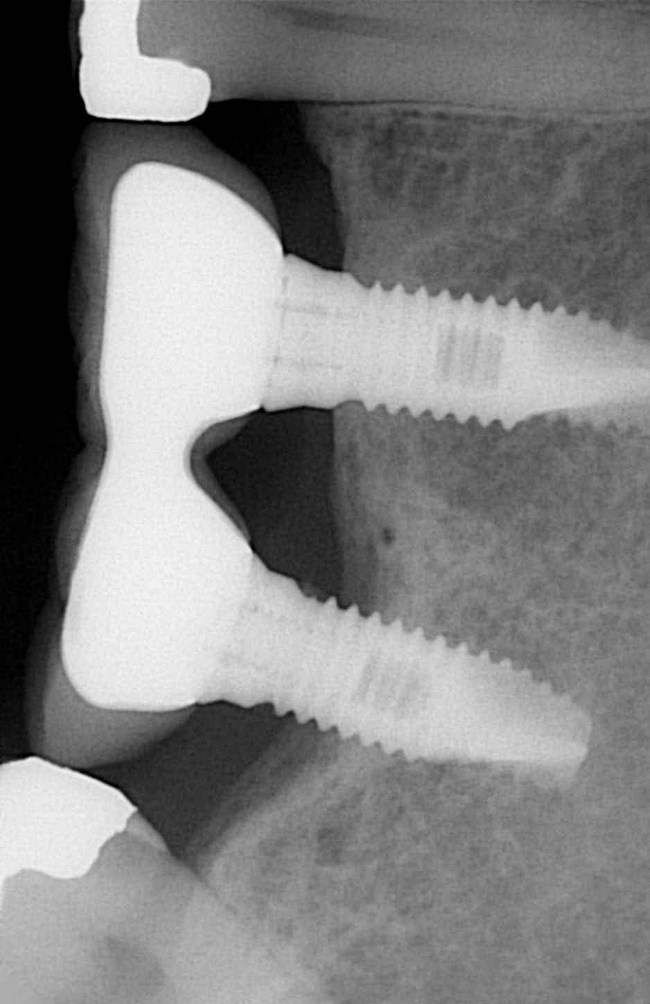 peri-implantite initiale peri implantite